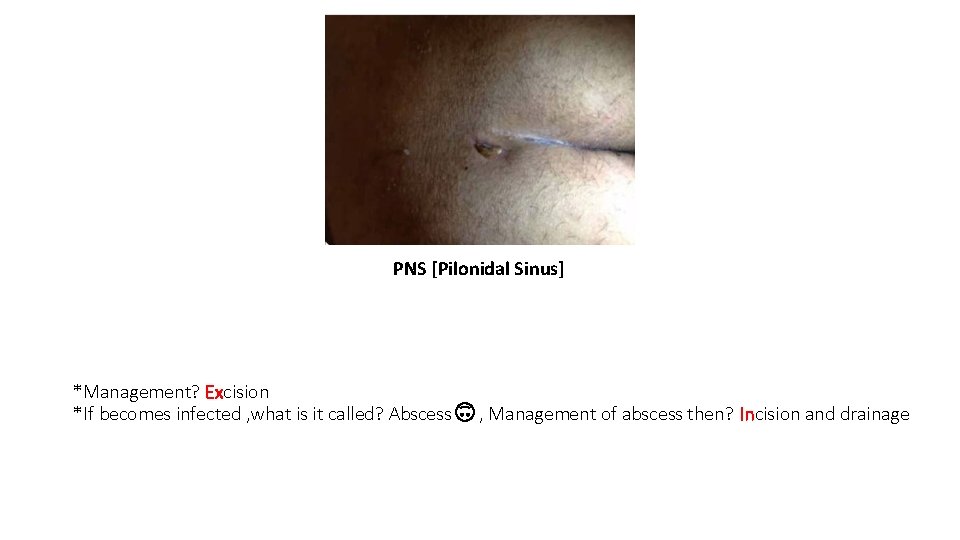 PNS [Pilonidal Sinus] *Management? Excision *If becomes infected , what is it called? Abscess