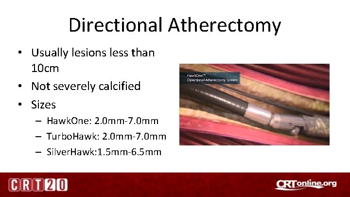 Directional Atherectomy • Usually lesions less than 10 cm • Not severely calcified •