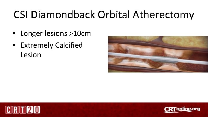 CSI Diamondback Orbital Atherectomy • Longer lesions >10 cm • Extremely Calcified Lesion 
