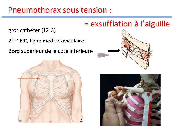 Pneumothorax sous tension : gros cathéter (12 G) = exsufflation à l’aiguille 2ème EIC,
