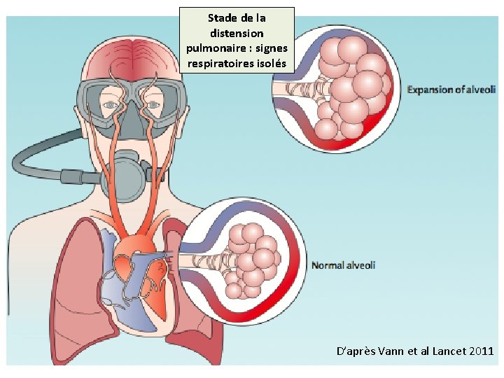 Stade de la distension pulmonaire : signes respiratoires isolés D’après Vann et al Lancet