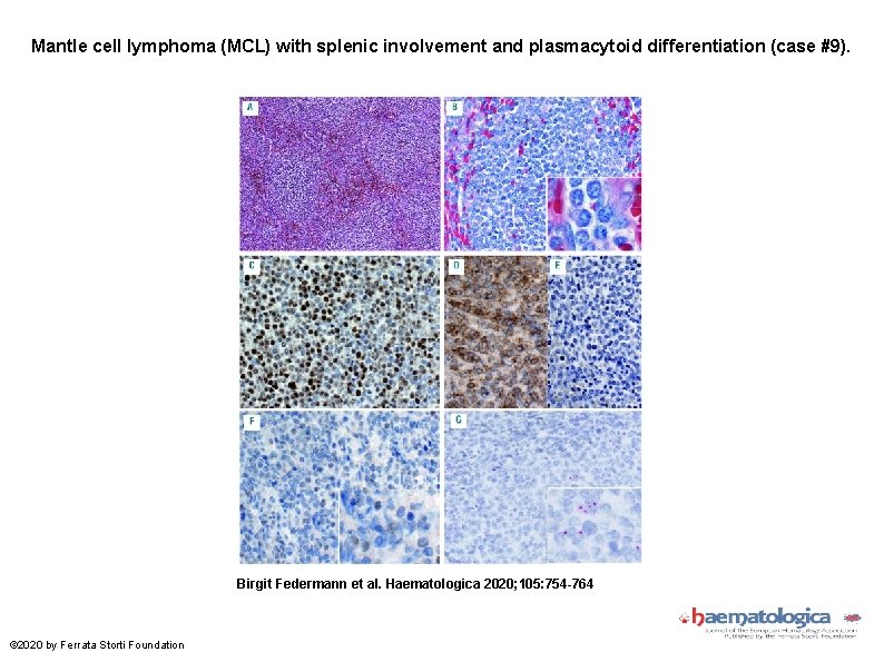 Mantle cell lymphoma (MCL) with splenic involvement and plasmacytoid differentiation (case #9). Birgit Federmann