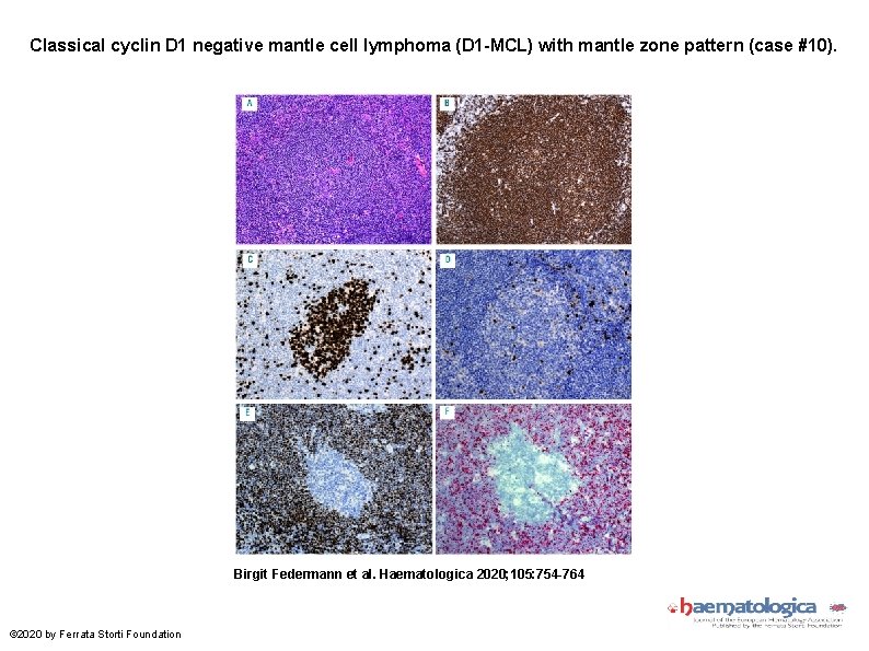 Classical cyclin D 1 negative mantle cell lymphoma (D 1 -MCL) with mantle zone
