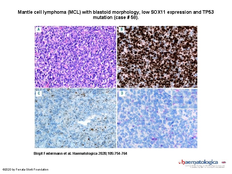 Mantle cell lymphoma (MCL) with blastoid morphology, low SOX 11 expression and TP 53