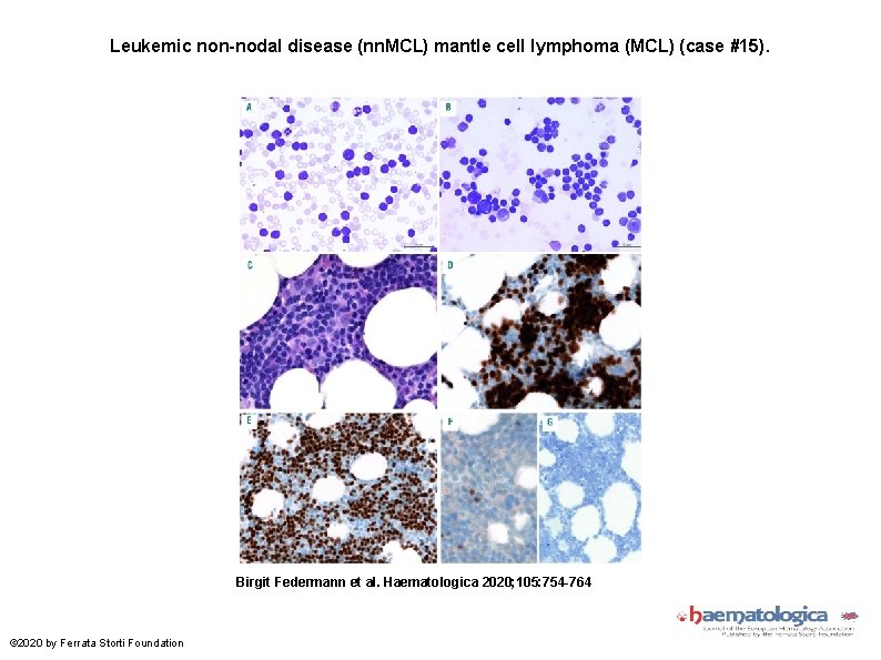 Leukemic non-nodal disease (nn. MCL) mantle cell lymphoma (MCL) (case #15). Birgit Federmann et