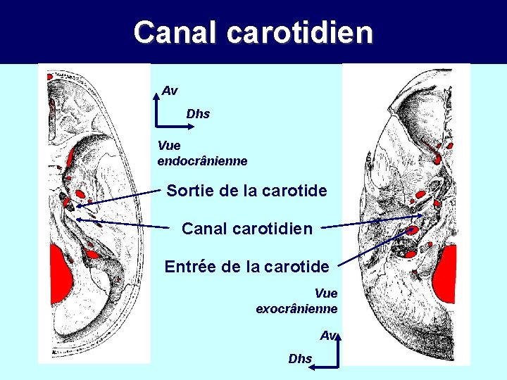 Canal carotidien Av Dhs Vue endocrânienne Sortie de la carotide Canal carotidien Entrée de