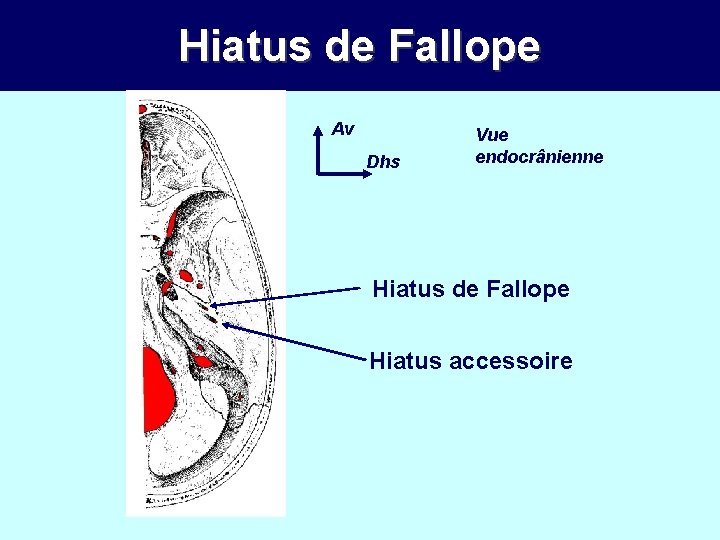 Hiatus de Fallope Av Dhs Vue endocrânienne Hiatus de Fallope Hiatus accessoire 