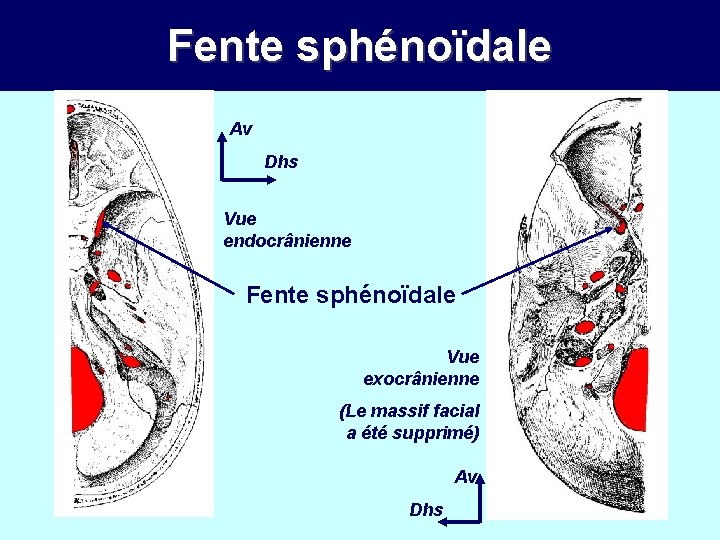 Fente sphénoïdale Av Dhs Vue endocrânienne Fente sphénoïdale Vue exocrânienne (Le massif facial a