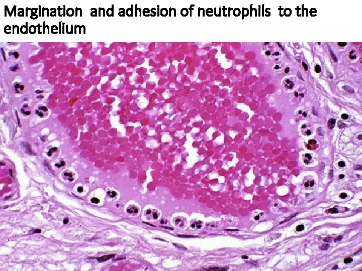 Margination and adhesion of neutrophils to the endothelium 