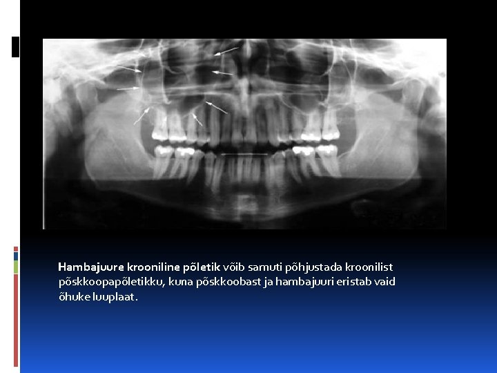Hambajuure krooniline põletik võib samuti põhjustada kroonilist põskkoopapõletikku, kuna põskkoobast ja hambajuuri eristab vaid