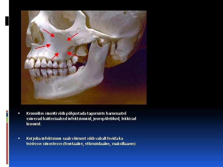  Kroonilise sinuiiti võib põhjustada tagumiste hammastel esinevad bakteriaalsed infektsioonid, juurepõletikud, lekkivad kroonid. Kui