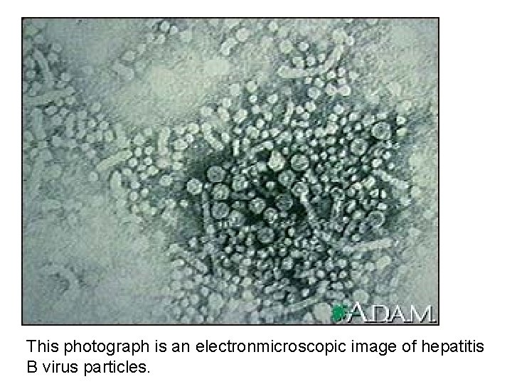 This photograph is an electronmicroscopic image of hepatitis B virus particles. 