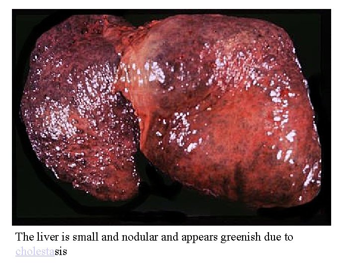 The liver is small and nodular and appears greenish due to cholestasis 