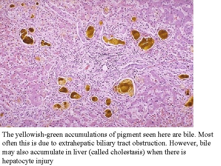 The yellowish-green accumulations of pigment seen here are bile. Most often this is due