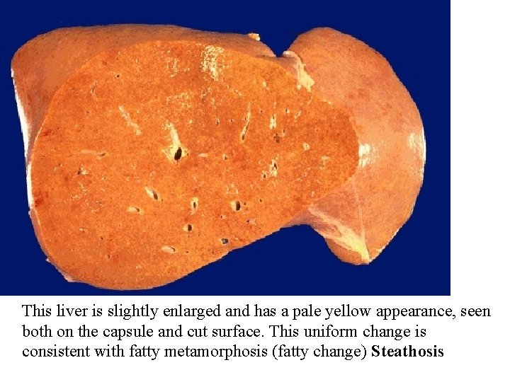 This liver is slightly enlarged and has a pale yellow appearance, seen both on