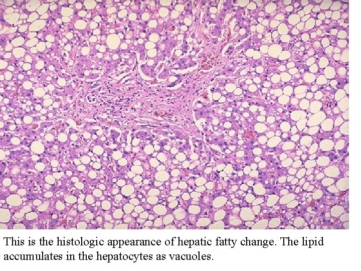 This is the histologic appearance of hepatic fatty change. The lipid accumulates in the