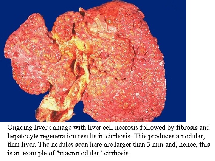 Ongoing liver damage with liver cell necrosis followed by fibrosis and hepatocyte regeneration results