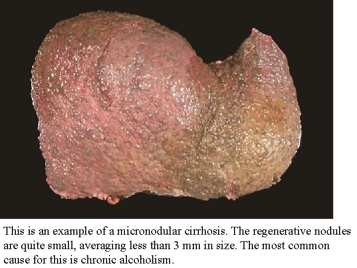 This is an example of a micronodular cirrhosis. The regenerative nodules are quite small,