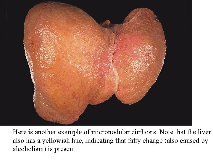 Here is another example of micronodular cirrhosis. Note that the liver also has a