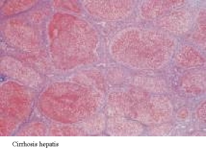 Cirrhosis hepatis 