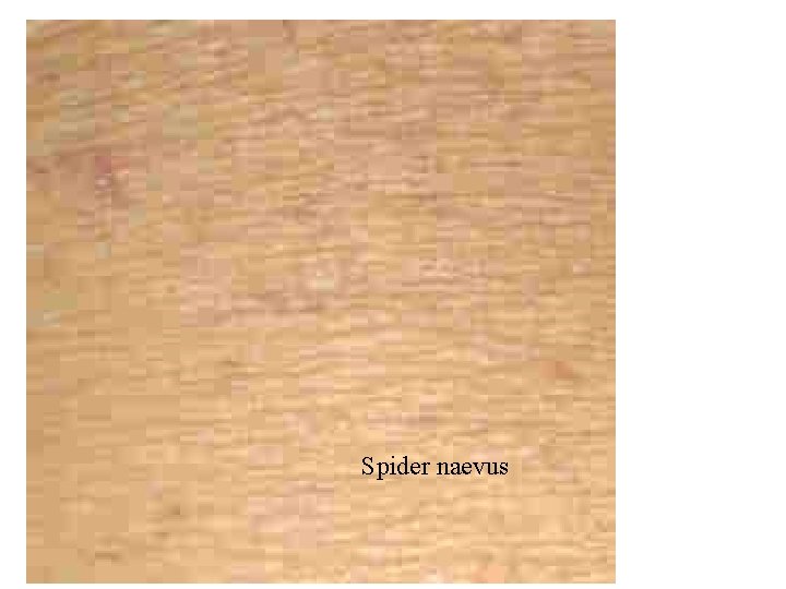 Spider naevus 
