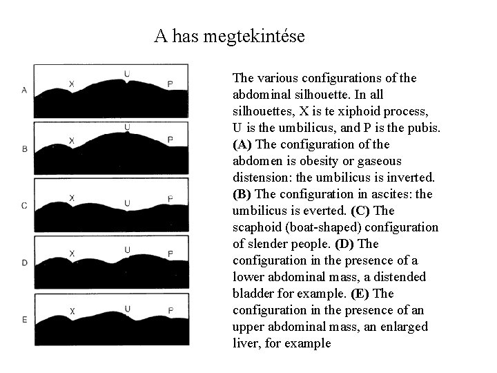 A has megtekintése The various configurations of the abdominal silhouette. In all silhouettes, X