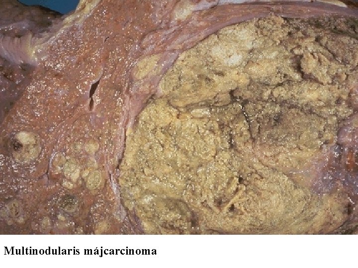 Multinodularis májcarcinoma 
