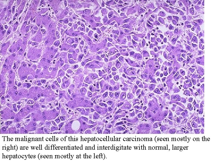 The malignant cells of this hepatocellular carcinoma (seen mostly on the right) are well