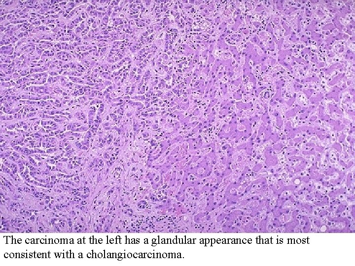 The carcinoma at the left has a glandular appearance that is most consistent with