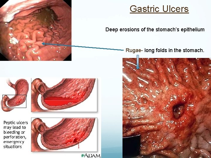Gastric Ulcers Deep erosions of the stomach’s epithelium Rugae- long folds in the stomach.