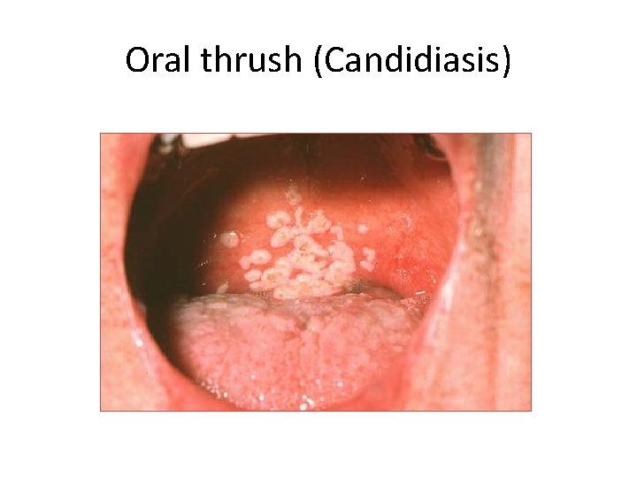 Oral thrush (Candidiasis) 