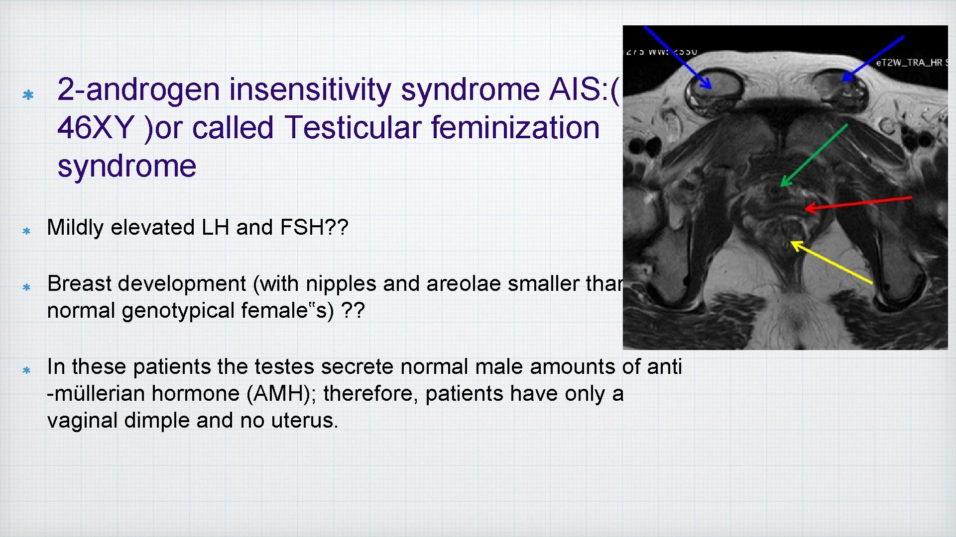 2 -androgen insensitivity syndrome AIS: ( 46 XY )or called Testicular feminization syndrome Mildly
