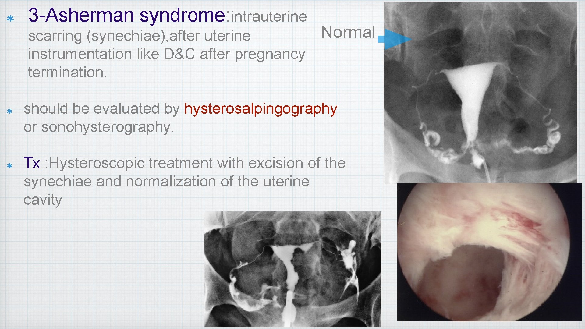 3 -Asherman syndrome: intrauterine Normal scarring (synechiae), after uterine instrumentation like D&C after pregnancy