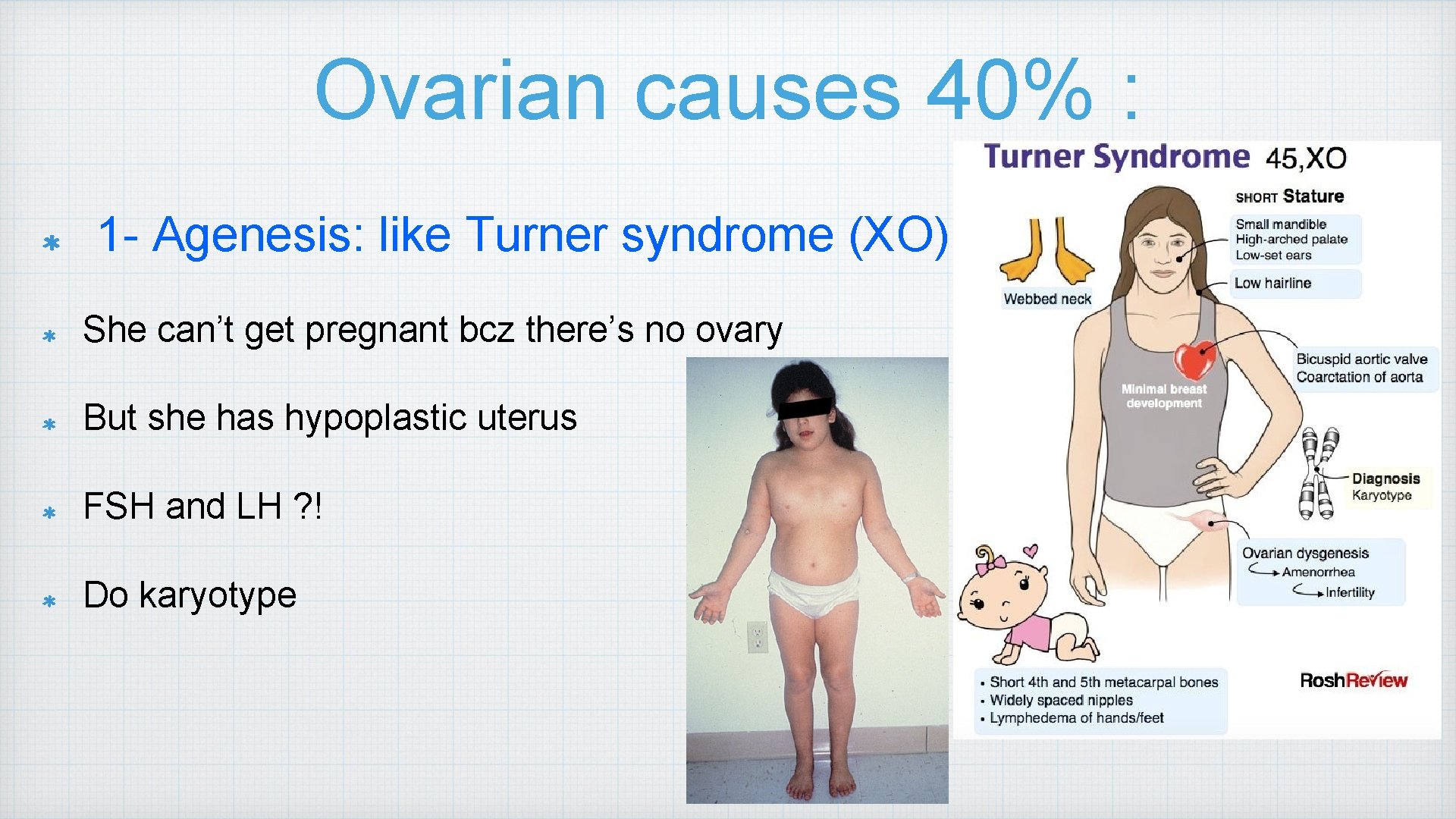 Ovarian causes 40% : 1 - Agenesis: like Turner syndrome (XO) She can’t get