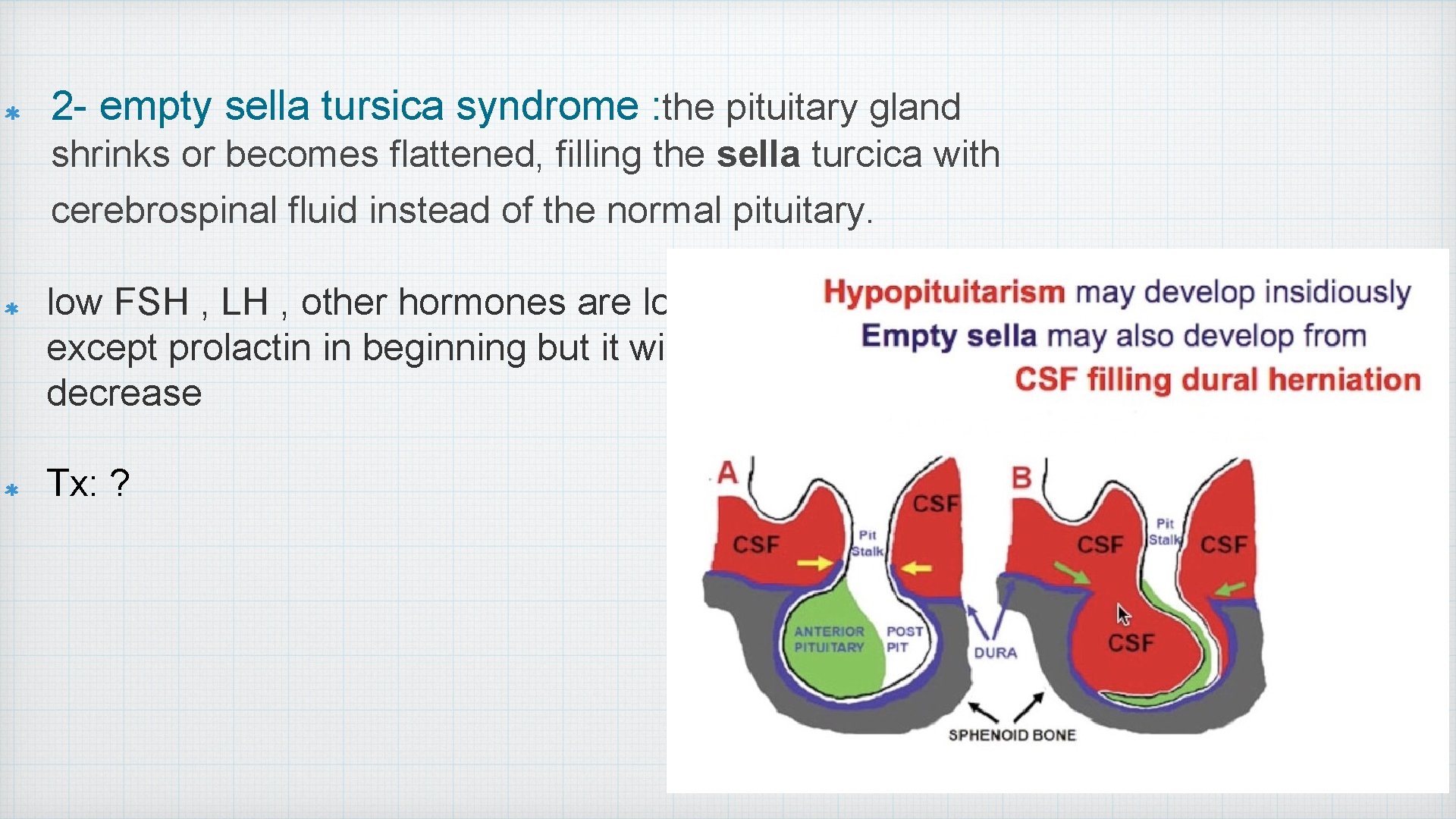 2 - empty sella tursica syndrome : the pituitary gland shrinks or becomes flattened,