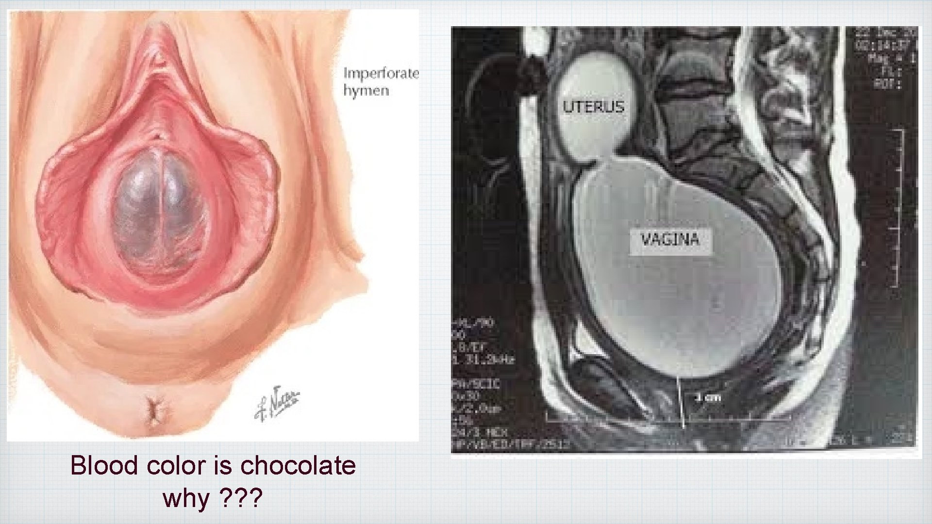 Blood color is chocolate why ? ? ? 