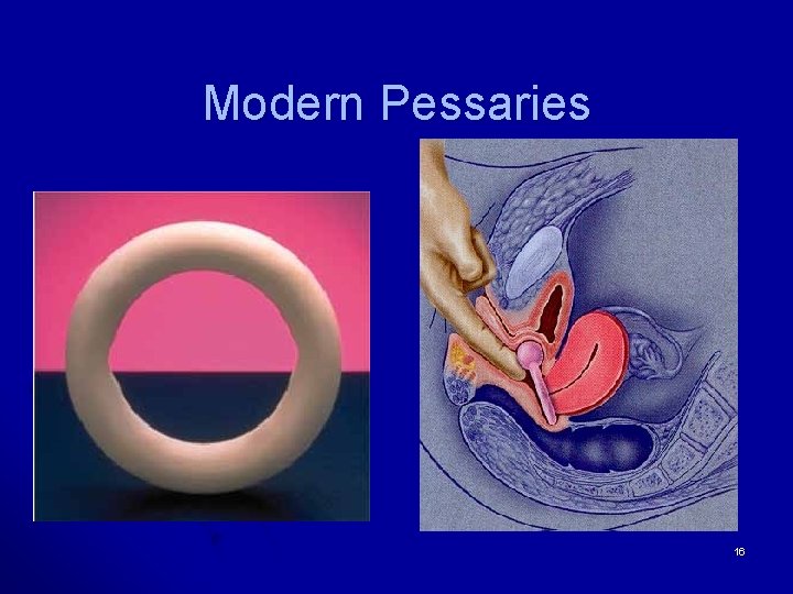 Modern Pessaries 16 
