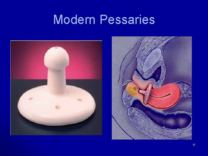 Modern Pessaries 17 