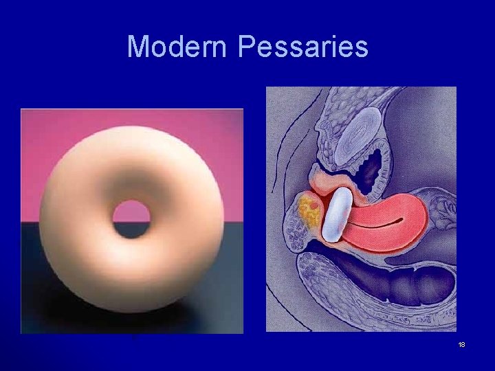 Modern Pessaries 18 