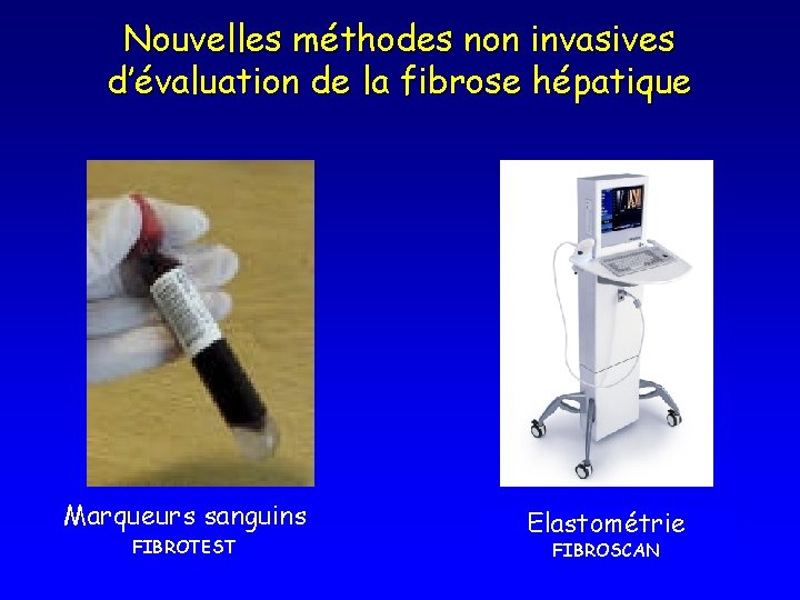 Nouvelles méthodes non invasives d’évaluation de la fibrose hépatique Marqueurs sanguins FIBROTEST Elastométrie FIBROSCAN