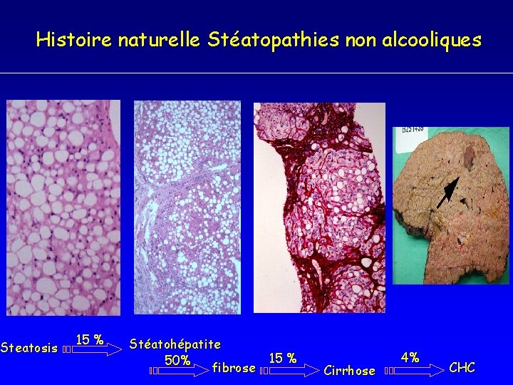 Histoire naturelle Stéatopathies non alcooliques Steatosis 15 % Stéatohépatite 50% fibrose 15 % Cirrhose