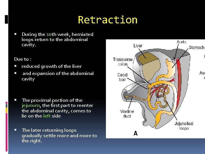 Retraction During the 10 th week, herniated loops return to the abdominal cavity. Due