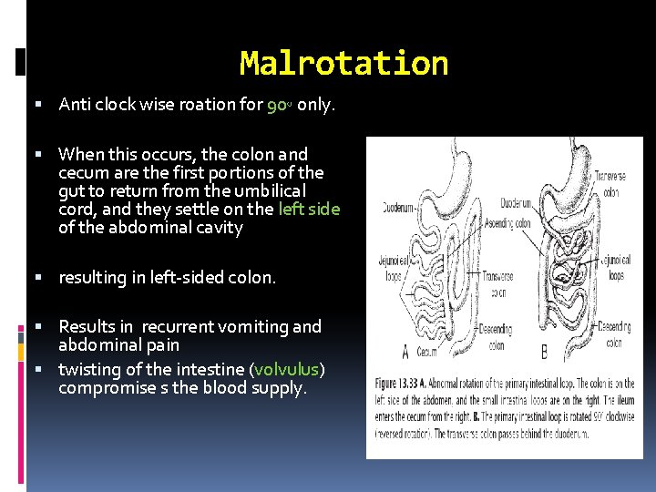Malrotation Anti clock wise roation for 90◦ only. When this occurs, the colon and