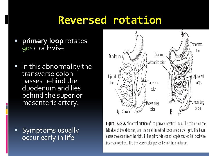 Reversed rotation primary loop rotates 90◦ clockwise In this abnormality the transverse colon passes