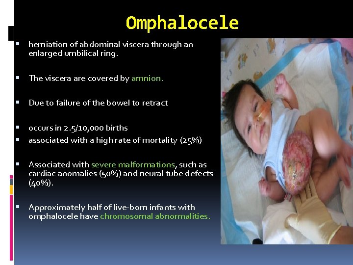 Omphalocele herniation of abdominal viscera through an enlarged umbilical ring. The viscera are covered