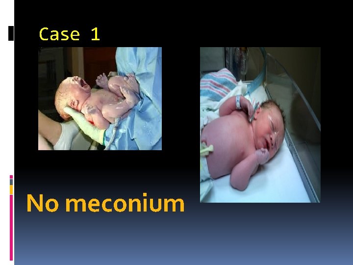 Case 1 No meconium 