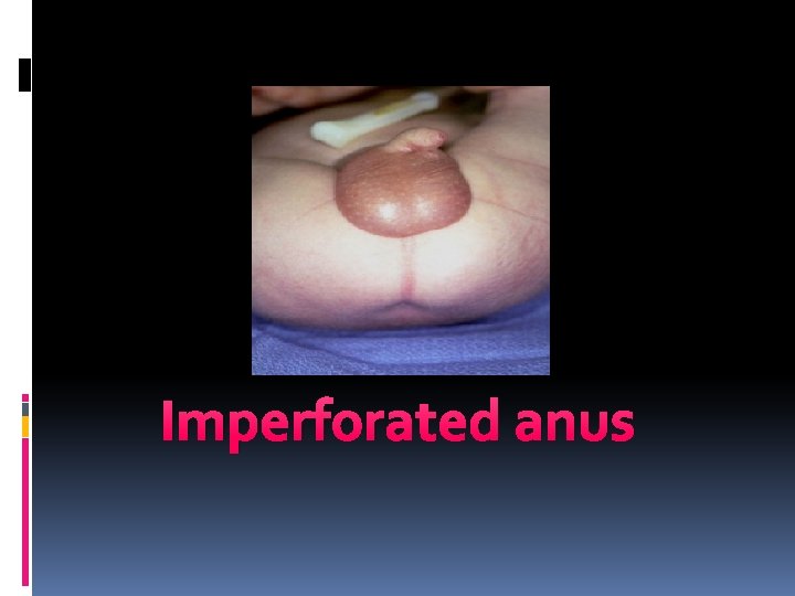 Imperforated anus 
