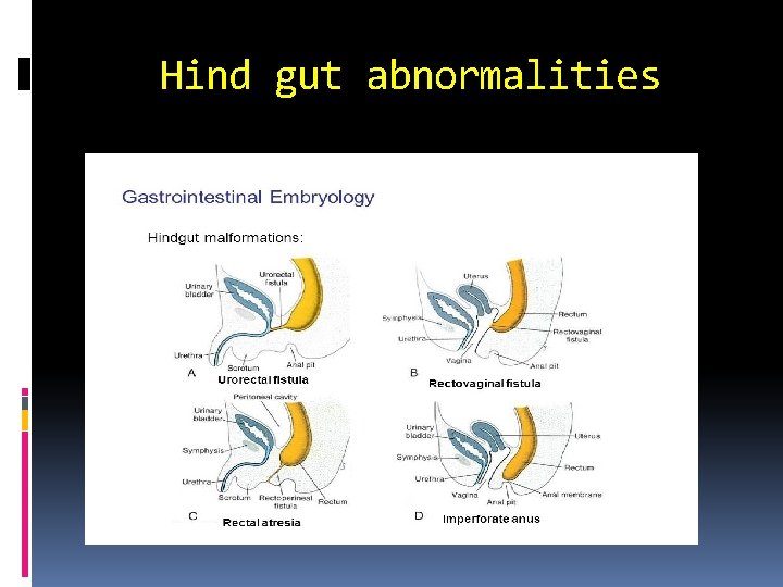 Hind gut abnormalities 