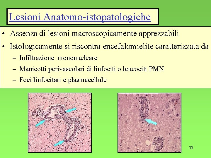 Lesioni Anatomo-istopatologiche • Assenza di lesioni macroscopicamente apprezzabili • Istologicamente si riscontra encefalomielite caratterizzata