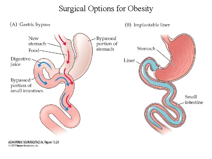 Surgical Options for Obesity 
